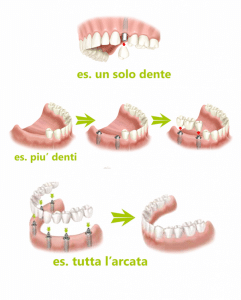 Casi Per Impianti Dentali 241x300