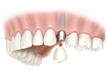 Implantologia Dentale