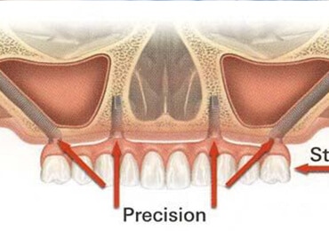 Implantologia Zigomatica 2