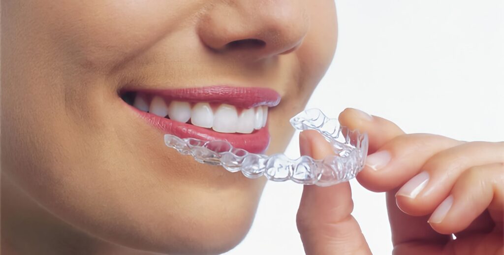Ortodonzia Correttiva Invisibile