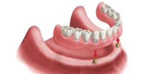 Overdenture 300x150 1