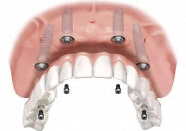 Protesi Dentale Fissa 1